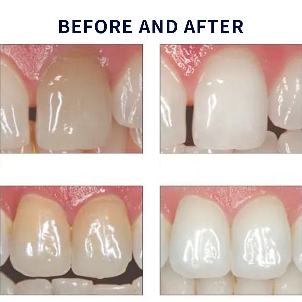 Opalescence Whitening 20% PF 2 - Teeth Whitening Levels ulasan dan harga