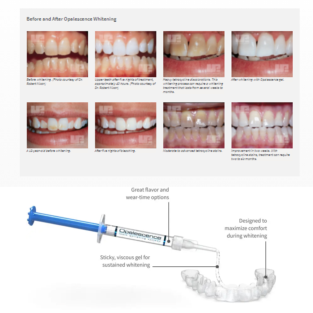 Opalescence Whitening 20% PF 2 - Teeth Whitening Levels ulasan dan harga