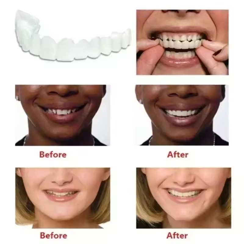 Veneer Gigi Pemutih Gigi Tirua - Teeth Whitening Procedure ulasan dan harga