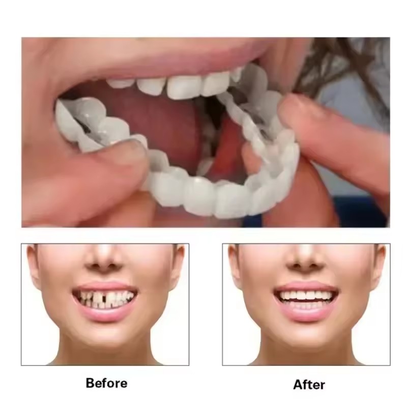 Veneer Gigi Pemutih Gigi Tirua - Teeth Whitening Procedure ulasan dan harga